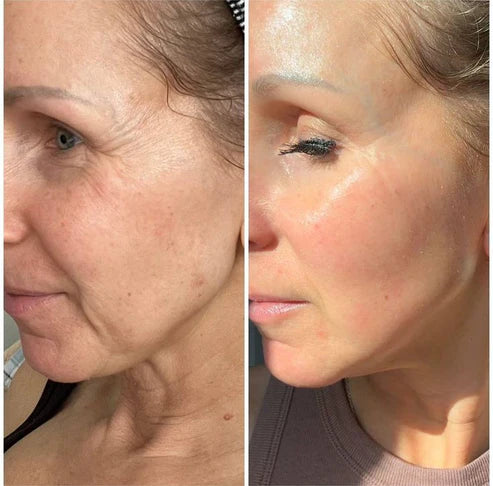 Piel más firme y cuello definido sin agujas ni dolor - LumiLift Pro